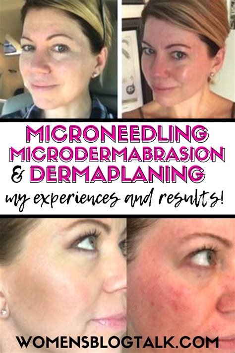 microneedling microdermabrasion and dermaplaning results and before and after photos