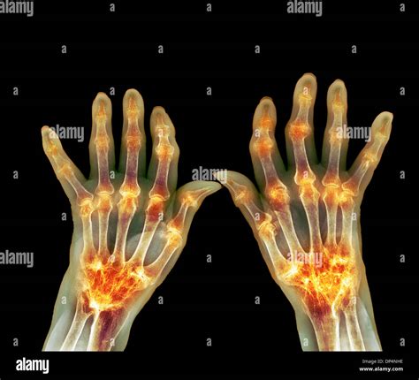 Rheumatoid Arthritis X Ray Stock Photo Alamy
