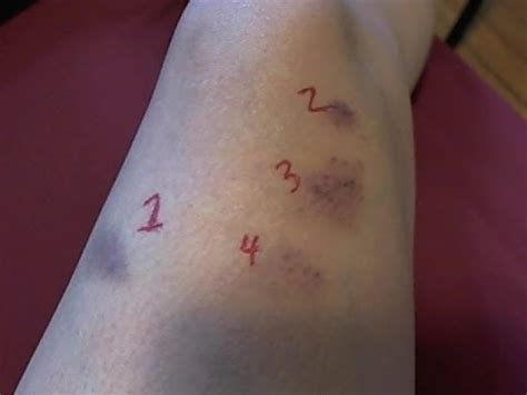 Heres some ways to bruise yourself…. How to cure your bruises - YouTube