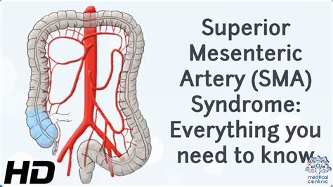my rare diagnosis story superior mesenteric artery syndrome youtube my xxx hot girl