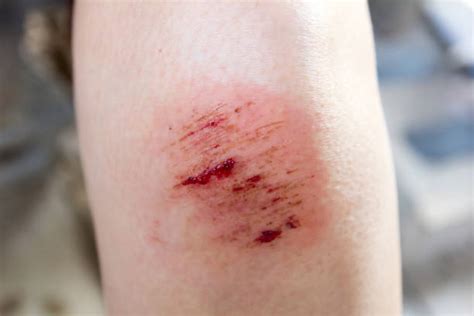 Bruised Knee Stock Photos Pictures And Royalty Free Images Istock