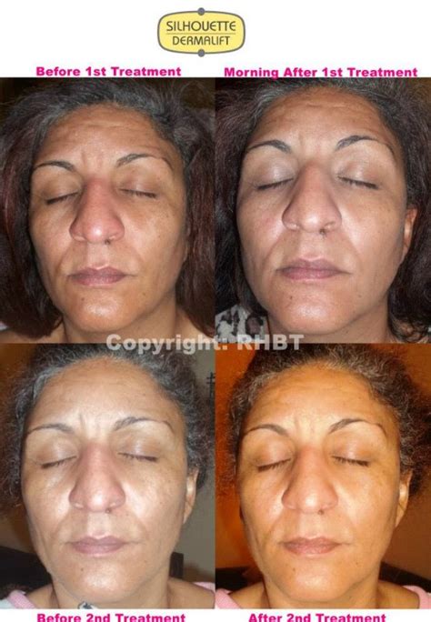 Dermalift Microcurrent Non Surgical Face Lifts In Stockport