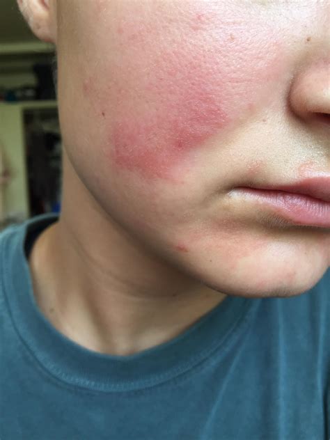 Burning Bumpy Rash Or Maybe Burn Picture Over The Counter Acne