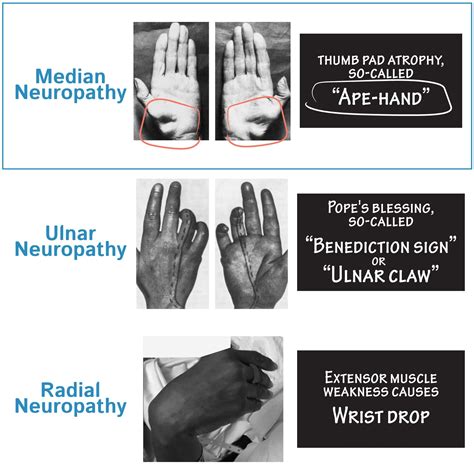 Neuroanatomy Glossary Median Neuropathy Ditki Medical And Biological