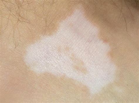 Skin Disorders That Cause Pigment Loss Livestrongcom