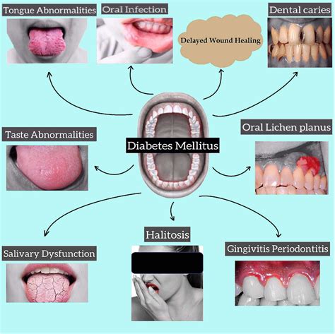 Figure 1 From Oral Health Messiers Diabetes Mellitus Relevance