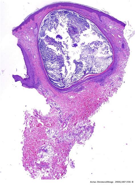 Milia En Plaque On The Posterior Surface Of Both Auricules Following