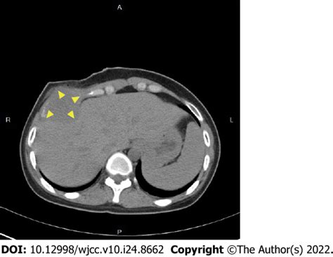 Traumatic Giant Cell Tumor Of Rib A Case Report