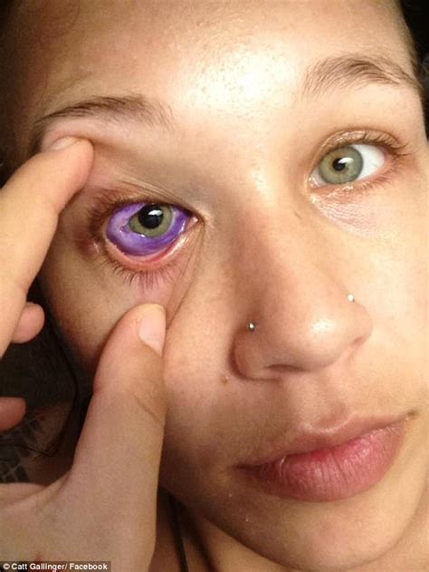 Canadian Models Eye Tattoo Goes Horribly Wrong Express Digest