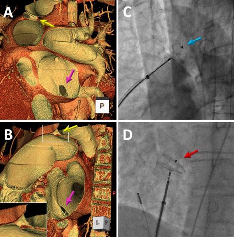 Treatment Strategy Of Transcatheter Closure In The Combination Of