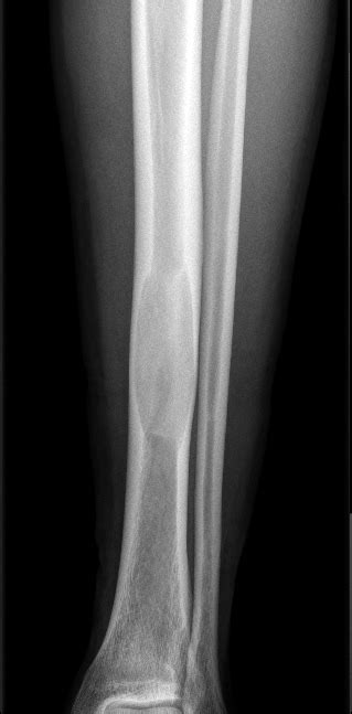 Fibrous dysplasia in tibia | Image | Radiopaedia.org