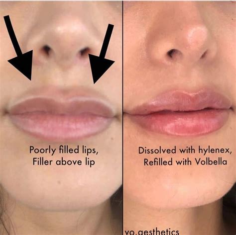 Pin By CyGht On Chirurgie Botox Lips Lips Inspiration Facial Aesthetics