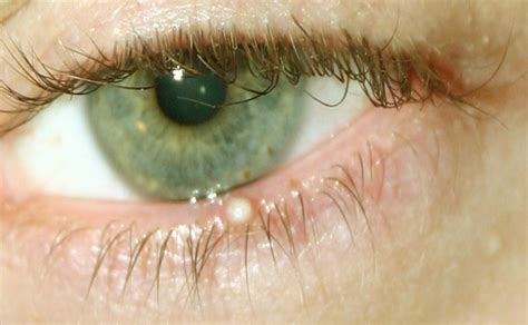 Causes Of Eyelid Bumps And How To Get Rid Of Them Med Health Net