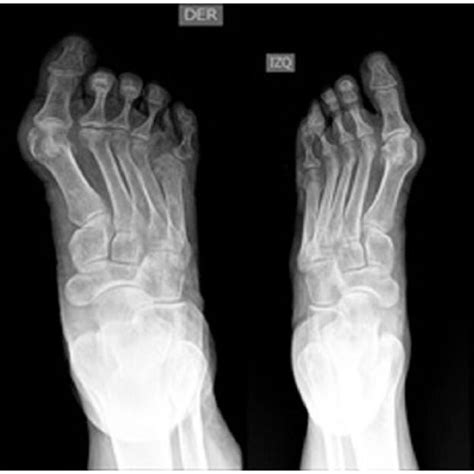Bilateral Fifth Toes Polydactyly A Rudimentary Supernumerary Toe Is