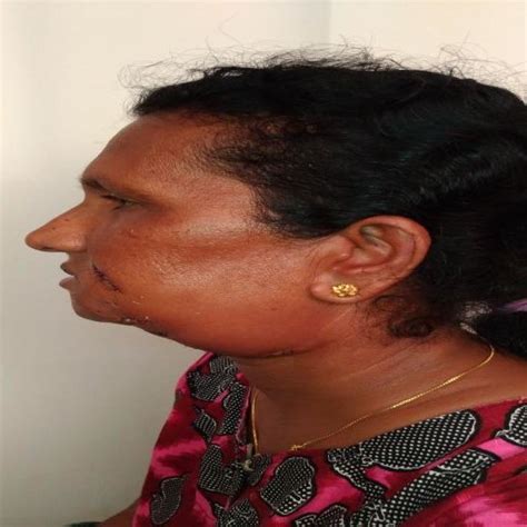 Large Diffuse Swelling Seen On The Left Lower Face Involving Left Cheek