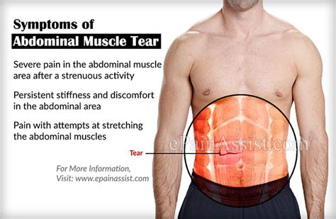 Always call your doctor if you have rib cage pain with Abdominal Muscle Tear|Causes|Symptoms|Treatment|Recovery ...
