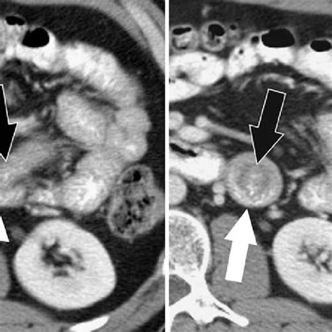 Ileal Intussusception In A 61 Year Old Man With Small Bowel Obstruction