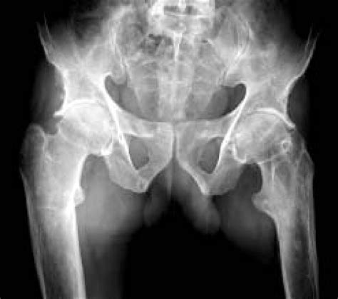 Anteroposterior Radiograph Of The Pelvis Including Both Hips Shows