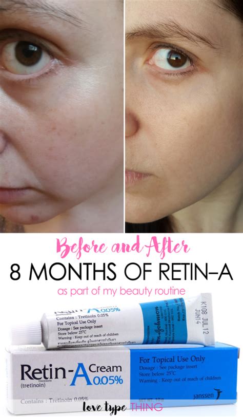 Before And After Retin A 8 Months Results Skin Care Skin Care Tips