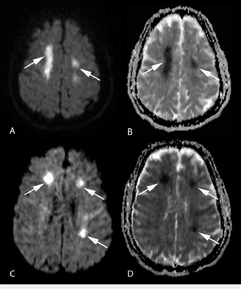 Mri Brain Showing Acute Ischemic Infarcts A And C Axial Dwi Images Of