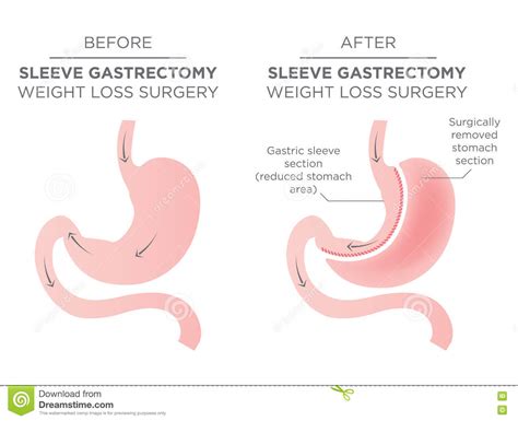 Bariatric Surgery Types Gastric Bypass Or Sleeve Gastrectomy Stock