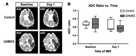 Glyburide Is Associated With Attenuated Vasogenic Edema In Stroke