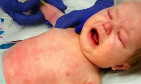 Mother S Photos Of Meningitis Rash Over Son S Body Daily Mail Online