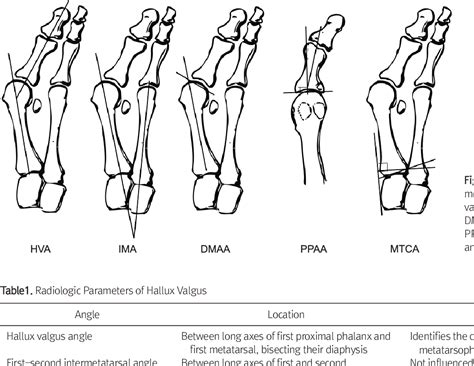 Figure 1 From Diagnosis And Pathophysiology Of Hallux Valgus Semantic