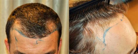 Frontal Balding Causes Symptoms Treatments Wimpole Clinic