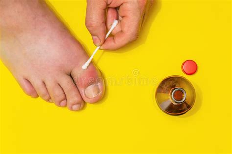 Gout On The Big Toe Treatment With Therapeutic Ointment Stock Image