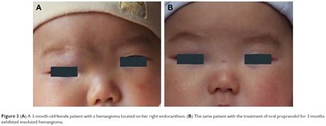 Propranolol Therapy For Infantile Hemangioma Our Experience Dddt