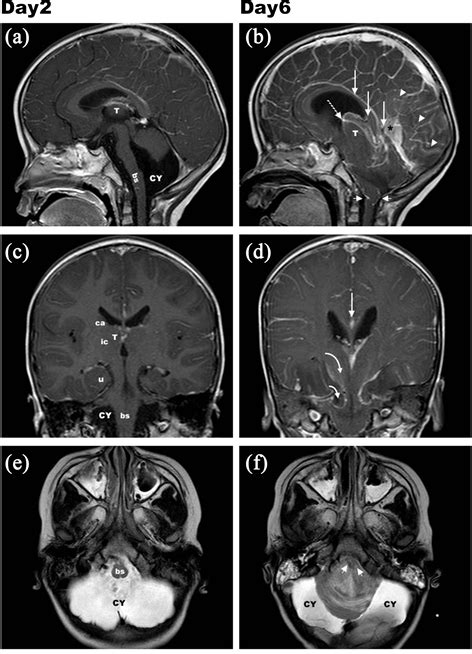 Cerebellar Herniation