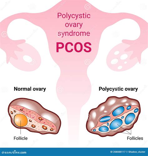Polycystic Ovary Syndrome Pcos Hormonal Diagnose Medical Illustration Stock Vector