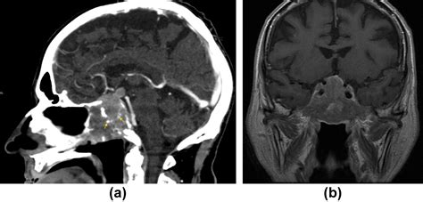 Benign And Malignant Diseases Of The Clivus Clinical Radiology