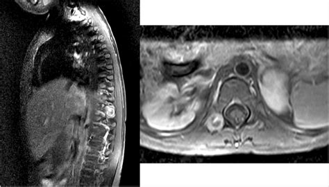 A B Mri Sagittal And Axial Images With Contrast Showing An Enhancing