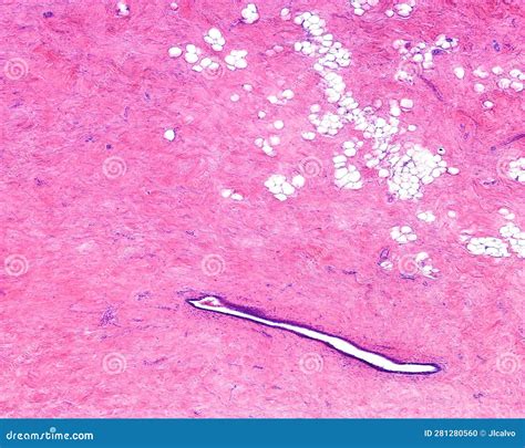 Human Breast Fibrocystic Change Stock Photo Image Of Micrograph