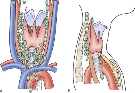 Thyroidectomy And Parathyroidectomy Clinical Gate