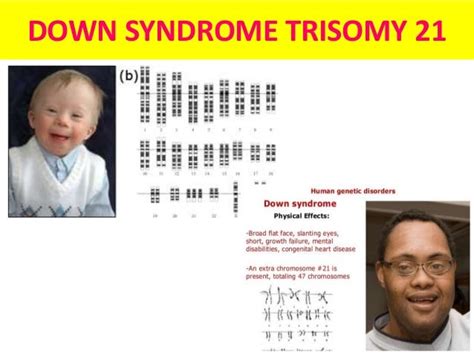 Glimpses Of Syndromes Of Chromosomal Abnormalities And Genetic Diseas