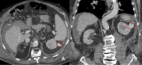 Retroperitoneal Bleed Ct Scan With Or Without Contrast Ct Scan Machine