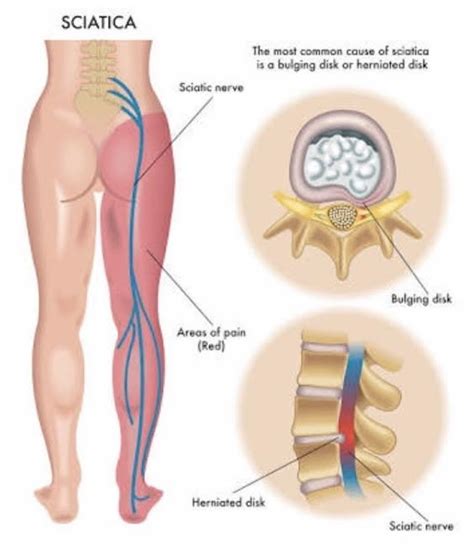 disc bulge treatment chiropractic perth chiro centre