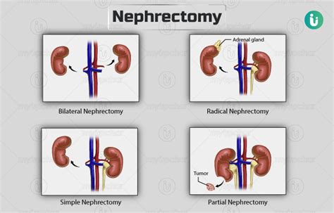 Nephrectomy Procedure Purpose Results Cost Price