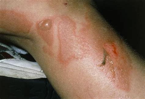 Image Staphylococcal Scalded Skin Syndrome Leg Msd Manual