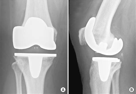 One Year Postoperative Radiographs Of The Right Knee Anteroposterior