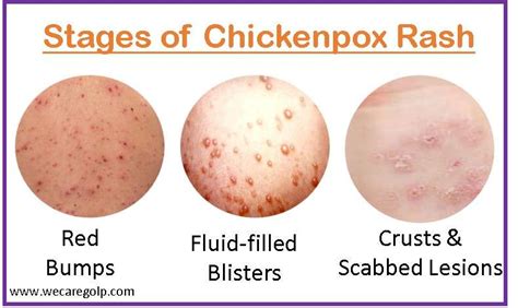 Chickenpox Varicella Zoster We Care