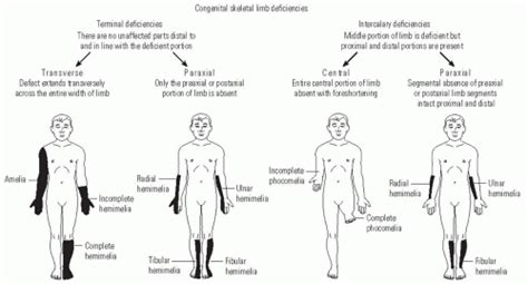 The Child With A Limb Deficiency Musculoskeletal Key