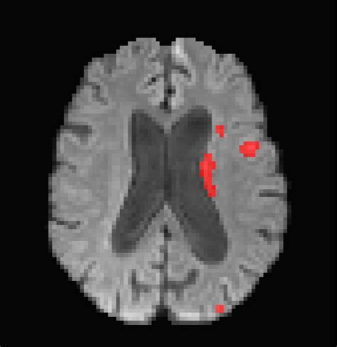 An Example Of 3d Mris Dwi Adc And Flair Images Showing Ischemic