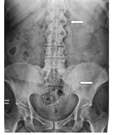 Plain X Ray Pelvis And Lumbosacral Spine Ap View Showing Stage 3