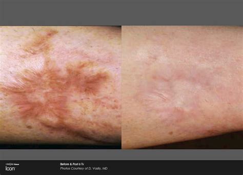 Scar Removal Before And After Images 4 Thin Md Med Spa