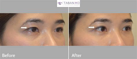 Before And After Asian Blepharoplasty Gallery Taban Md