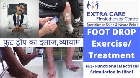 Foot Drop Treatment And Exercise Through Fes Functional Electrical